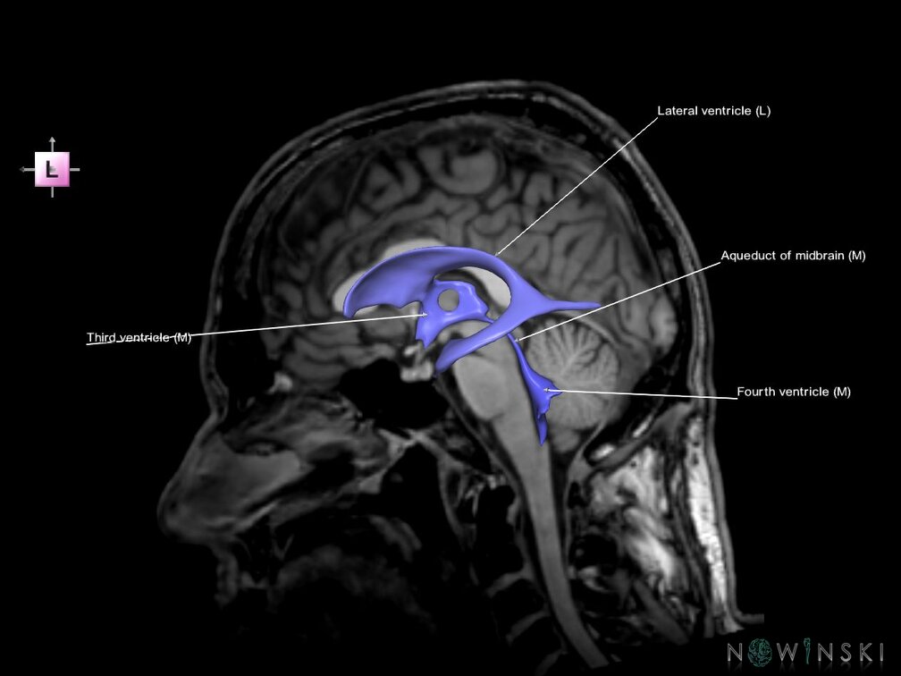 G6.T12.V2.P00S.Cerebral ventricles–Triplanar