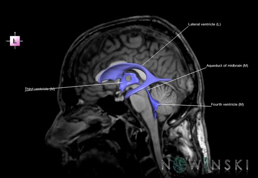 G6.T12.V2.P00S.Cerebral ventricles–Triplanar