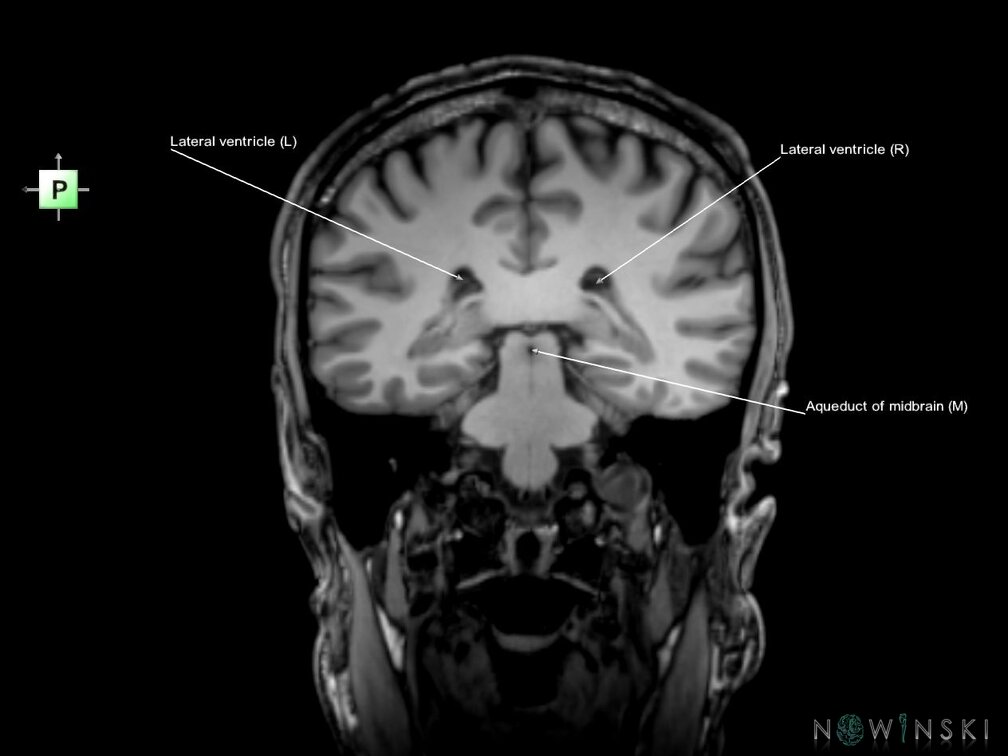 G6.T12.V3.P-34.Cerebral ventricles–Triplanar