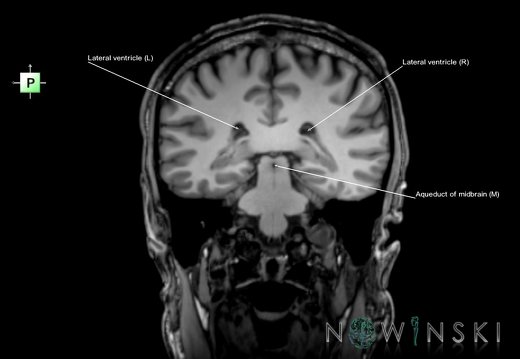 G6.T12.V3.P-34.Cerebral ventricles–Triplanar