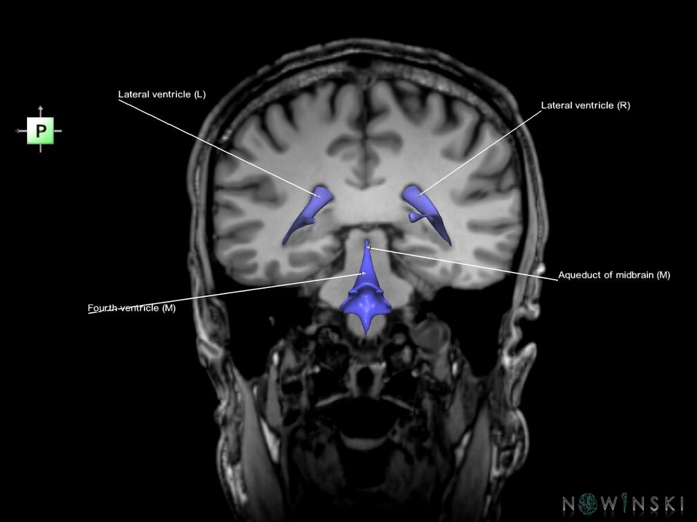 G6.T12.V3.P-34S.Cerebral ventricles–Triplanar