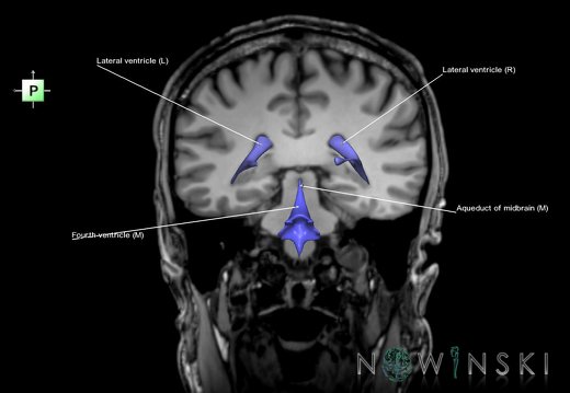 G6.T12.V3.P-34S.Cerebral ventricles–Triplanar