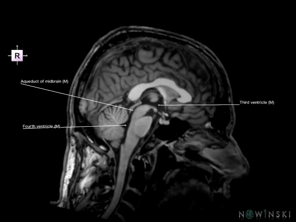 G6.T12.V4.P00.Cerebral ventricles–Triplanar