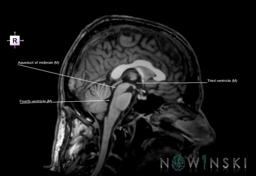 G6.T12.V4.P00.Cerebral ventricles–Triplanar