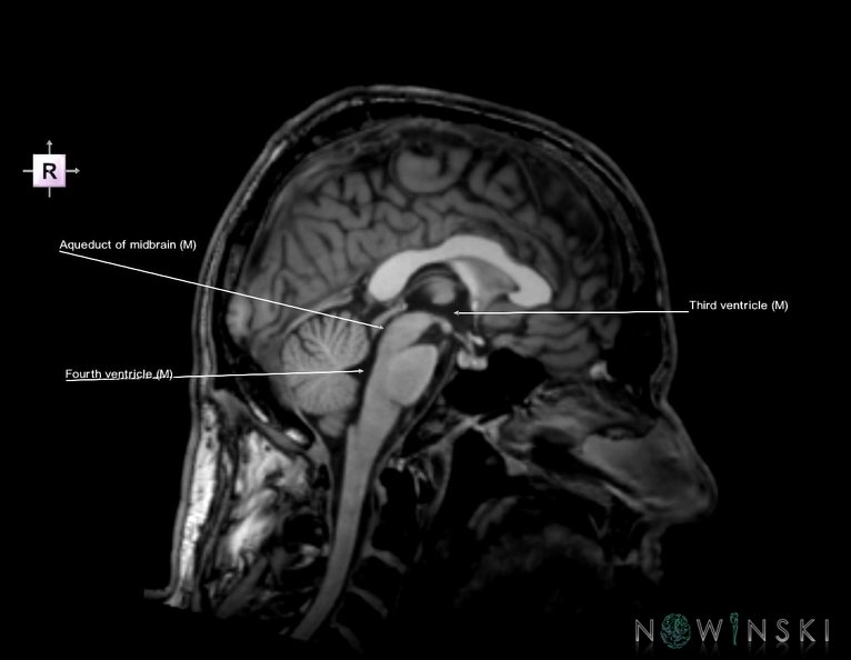 G6.T12.V4.P00.Cerebral_ventricles–Triplanar.tiff