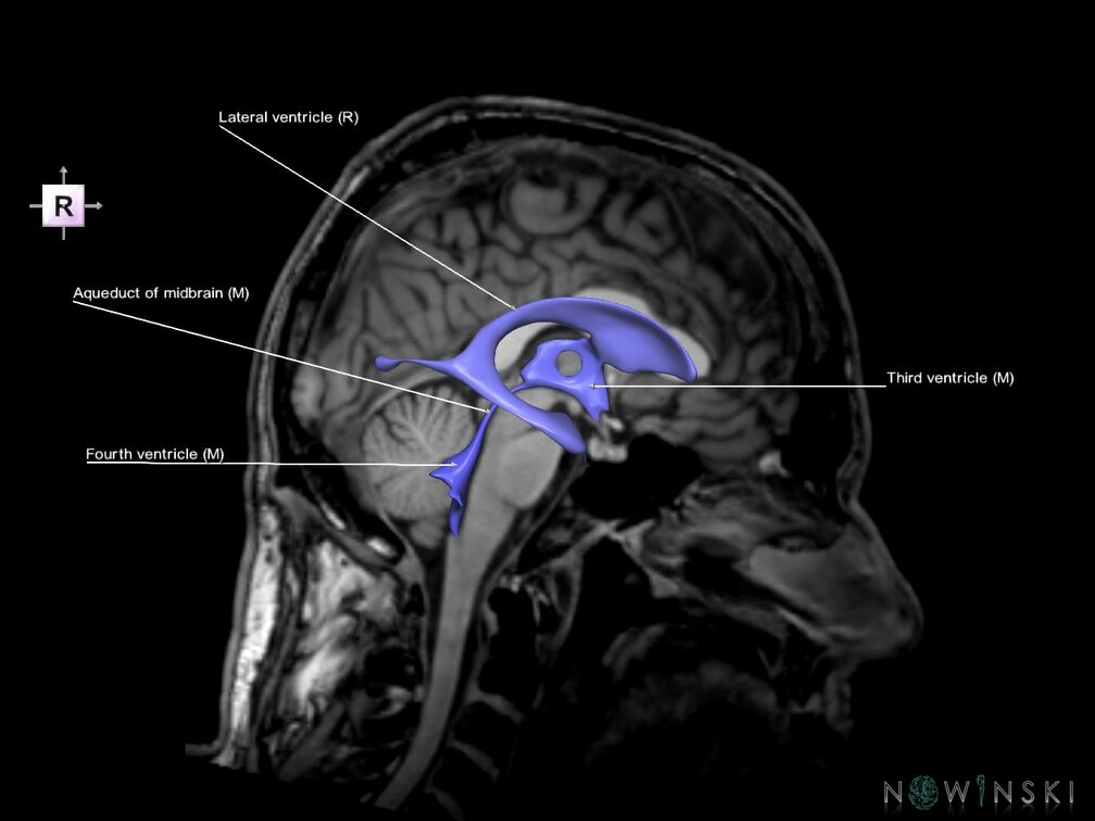 G6.T12.V4.P00S.Cerebral ventricles–Triplanar