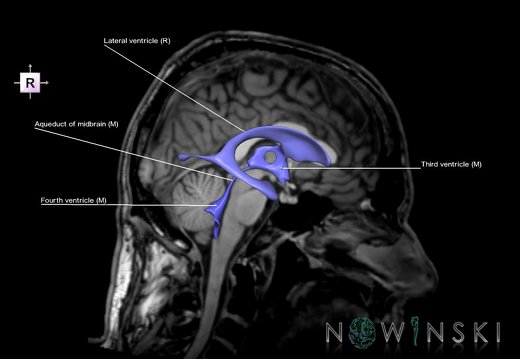 G6T12.CerebralVentricles–Triplanar