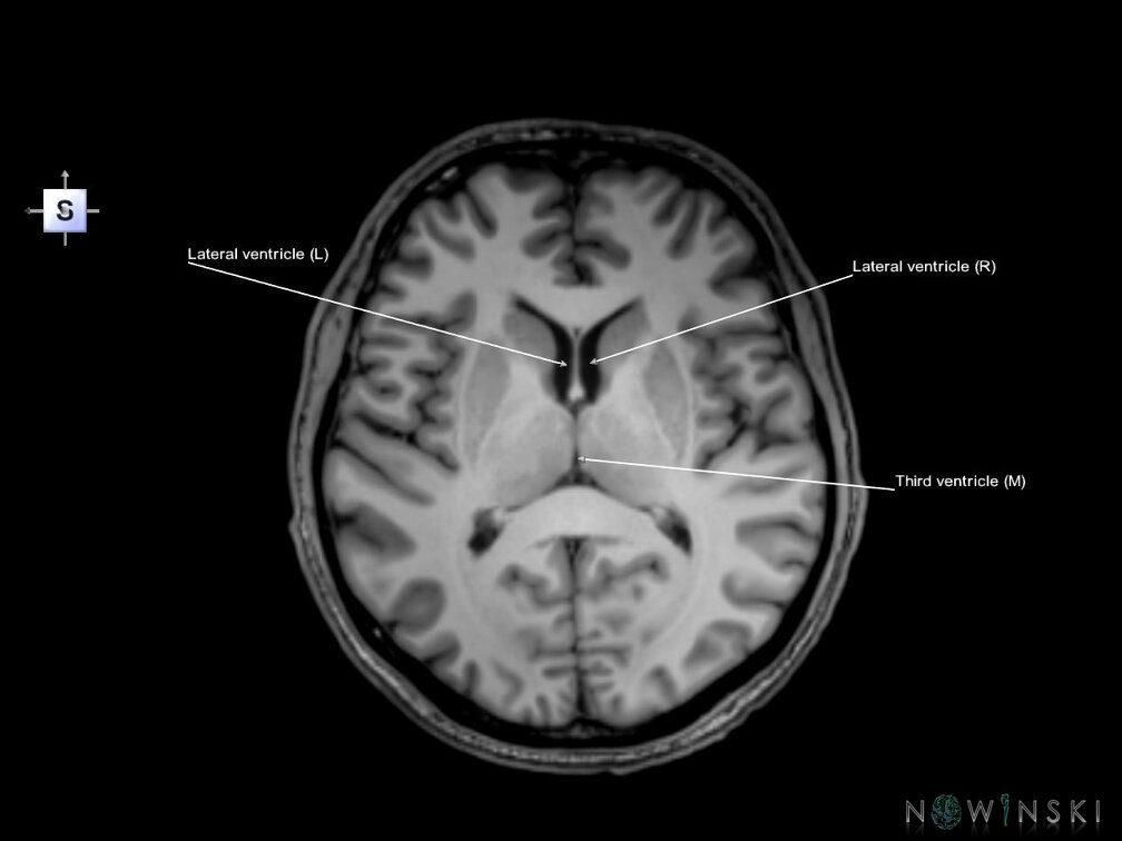 G6.T12.V5.P09.Cerebral ventricles–Triplanar