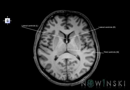 G6.T12.V5.P09.Cerebral ventricles–Triplanar