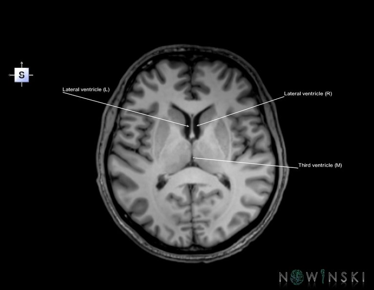 G6.T12.V5.P09.Cerebral_ventricles–Triplanar.tiff