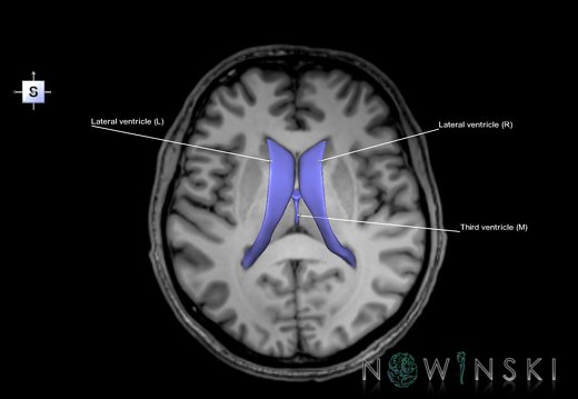 G6.T12.V5.P09S.Cerebral ventricles–Triplanar