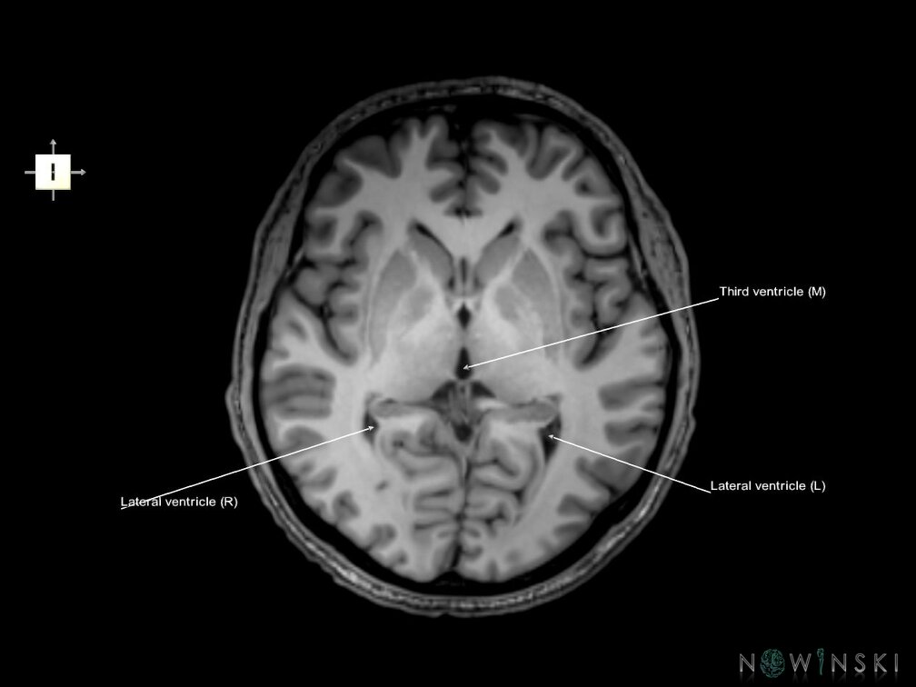 G6.T12.V6.P02.Cerebral ventricles–Triplanar