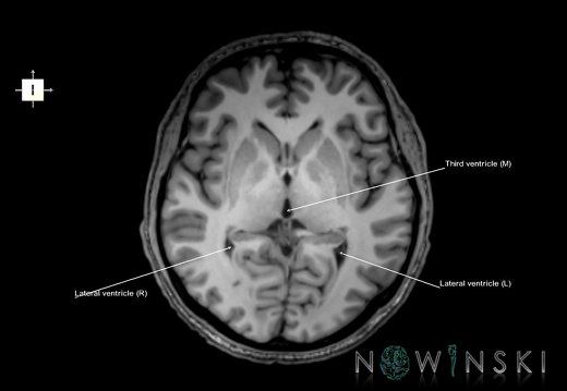 G6.T12.V6.P02.Cerebral ventricles–Triplanar