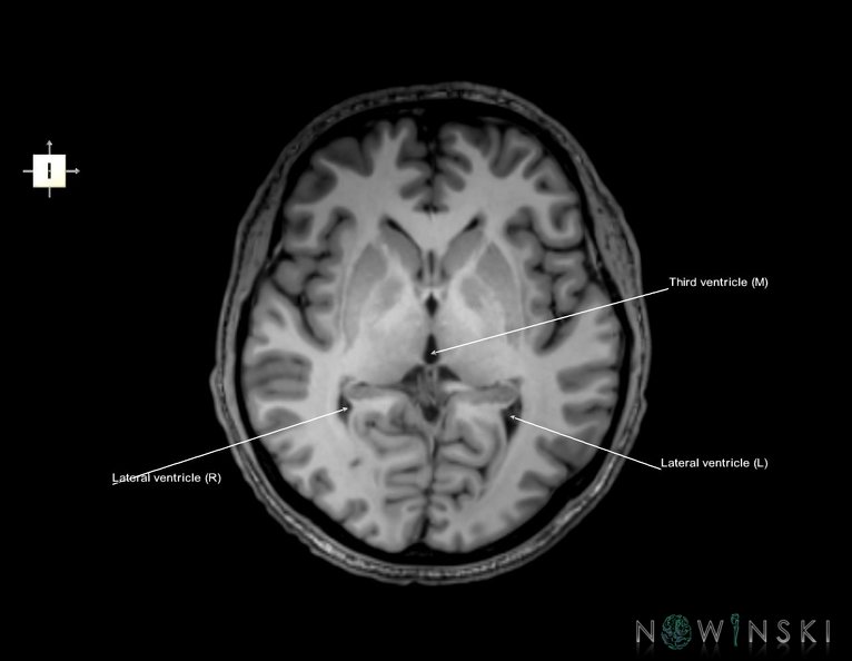 G6.T12.V6.P02.Cerebral_ventricles–Triplanar.tiff
