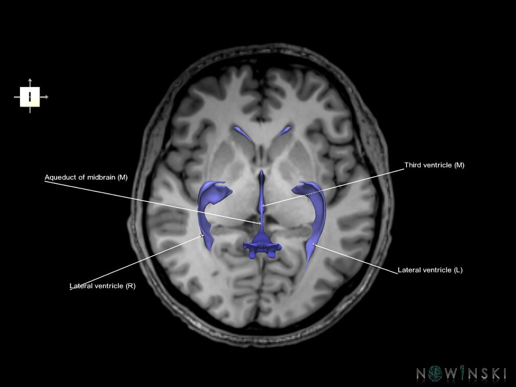 G6.T12.V6.P02S.Cerebral ventricles–Triplanar