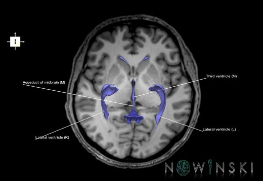 G6.T12.V6.P02S.Cerebral ventricles–Triplanar