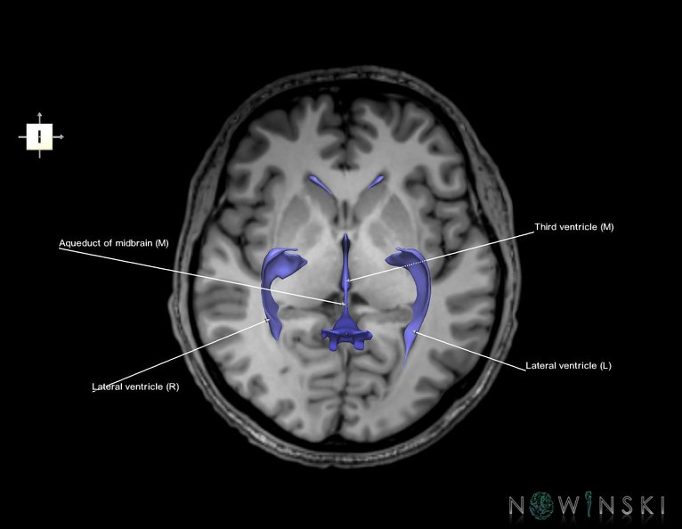 G6.T12.V6.P02S.Cerebral_ventricles–Triplanar.tiff