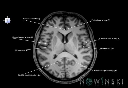 G6.T15.2.V5.P10.Intracranial arteries–Triplanar