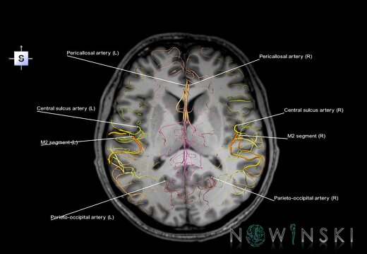 G6.T15.2.V5.P10S.Intracranial arteries–Triplanar