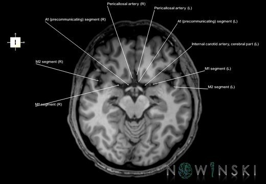 G6.T15.2.V6.P-10.Intracranial arteries–Triplanar