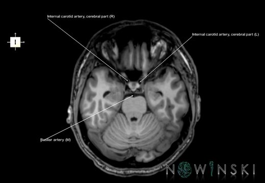 G6.T15.2.V6.P-20.Intracranial arteries–Triplanar