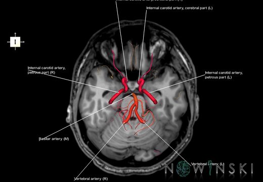 G6.T15.2.V6.P-20S.Intracranial arteries–Triplanar