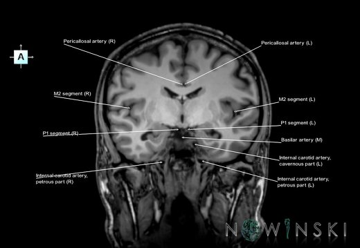 G6.T15.2.V1.P-10.Intracranial arteries–Triplanar