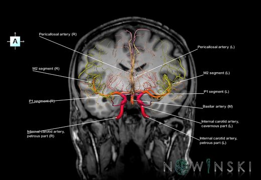 G6.T15.2.V1.P-10S.Intracranial arteries–Triplanar