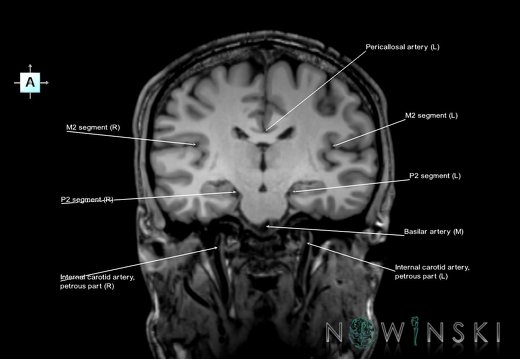 G6.T15.2.V1.P-20.Intracranial arteries–Triplanar