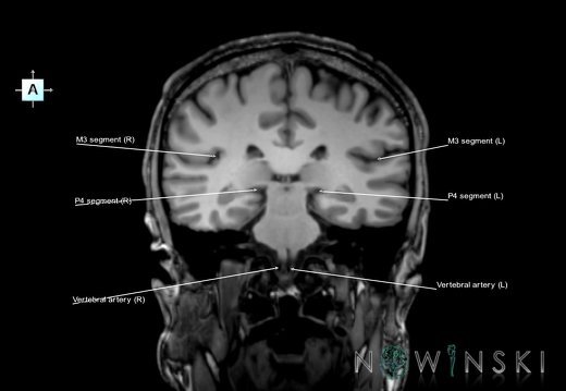 G6.T15.2.V1.P-30.Intracranial arteries–Triplanar