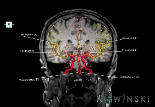 G6.T15.2.V1.P-30S.Intracranial arteries–Triplanar