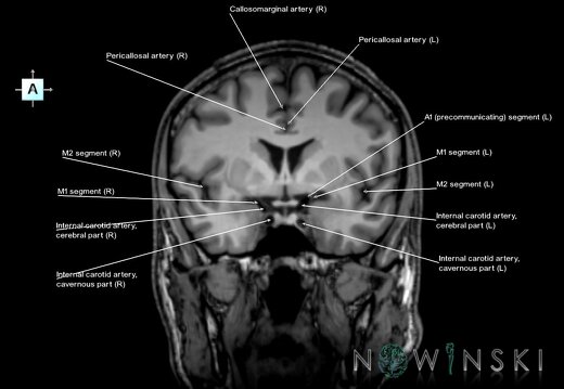 G6.T15.2.V1.P00.Intracranial arteries–Triplanar