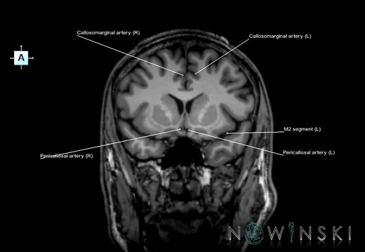 G6.T15.2.V1.P10.Intracranial arteries–Triplanar