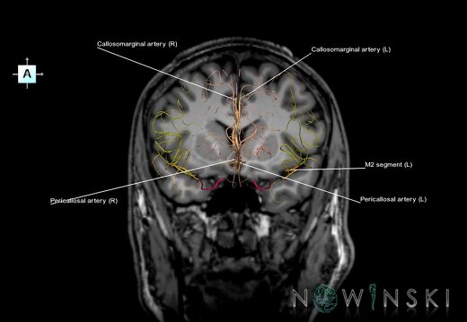 G6.T15.2.V1.P10S.Intracranial arteries–Triplanar