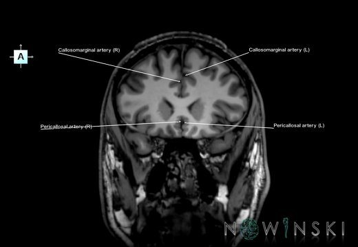 G6.T15.2.V1.P20.Intracranial arteries–Triplanar