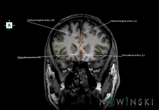 G6.T15.2.V1.P20S.Intracranial arteries–Triplanar