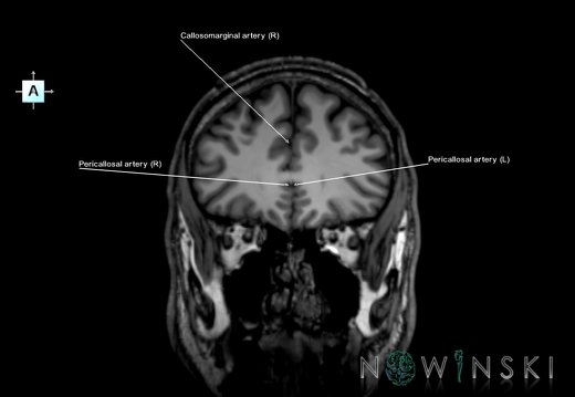 G6.T15.2.V1.P30.Intracranial arteries–Triplanar