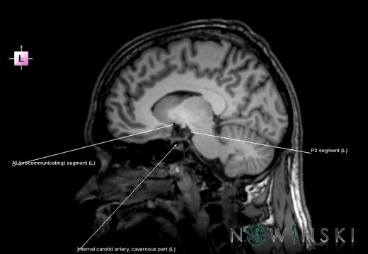 G6.T15.2.V2.P10.Intracranial arteries–Triplanar