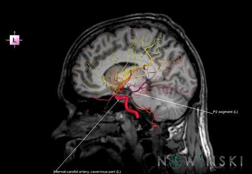 G6.T15.2.V2.P10S.Intracranial arteries–Triplanar