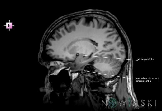 G6.T15.2.V2.P20.Intracranial arteries–Triplanar