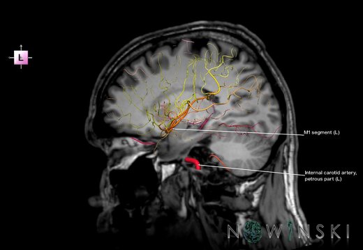 G6.T15.2.V2.P20S.Intracranial arteries–Triplanar