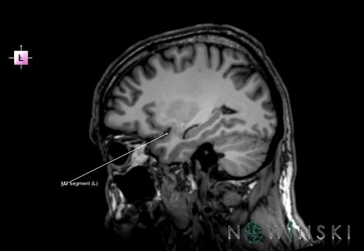 G6.T15.2.V2.P30.Intracranial arteries–Triplanar