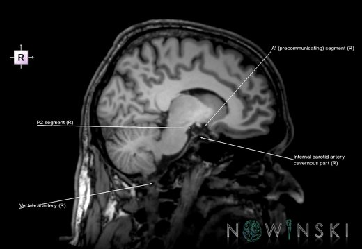 G6.T15.2.V4.P-10.Intracranial arteries–Triplanar