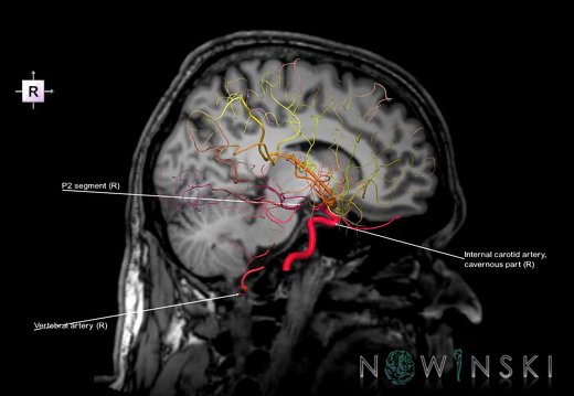 G6.T15.2.V4.P-10S.Intracranial arteries–Triplanar