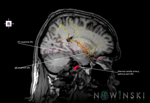 G6.T15.2.V4.P-20S.Intracranial arteries–Triplanar