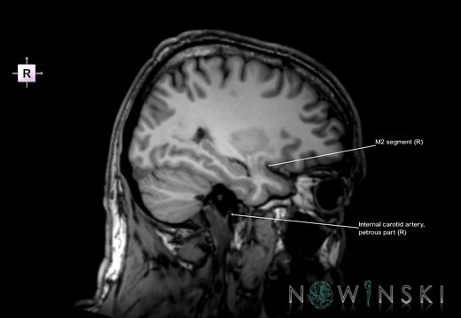 G6.T15.2.V4.P-30.Intracranial arteries–Triplanar