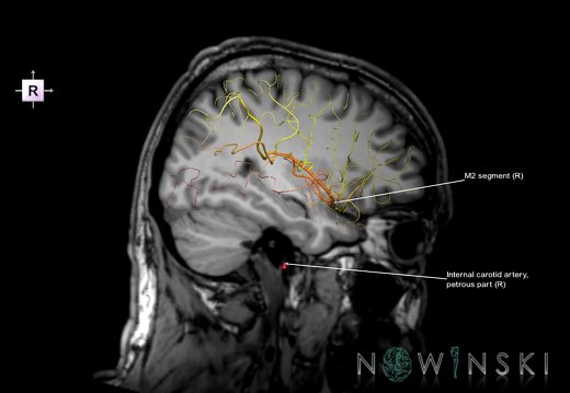 G6.T15.2.V4.P-30S.Intracranial arteries–Triplanar