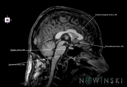 G6.T15.2.V4.P00.Intracranial arteries–Triplanar