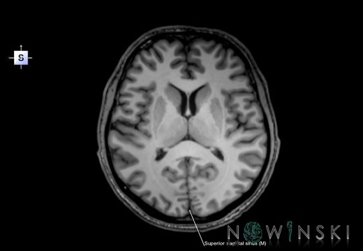 G6.T16.4.V5.P10.Dural sinuses–Triplanar