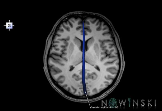 G6.T16.4.V5.P10S.Dural sinuses–Triplanar